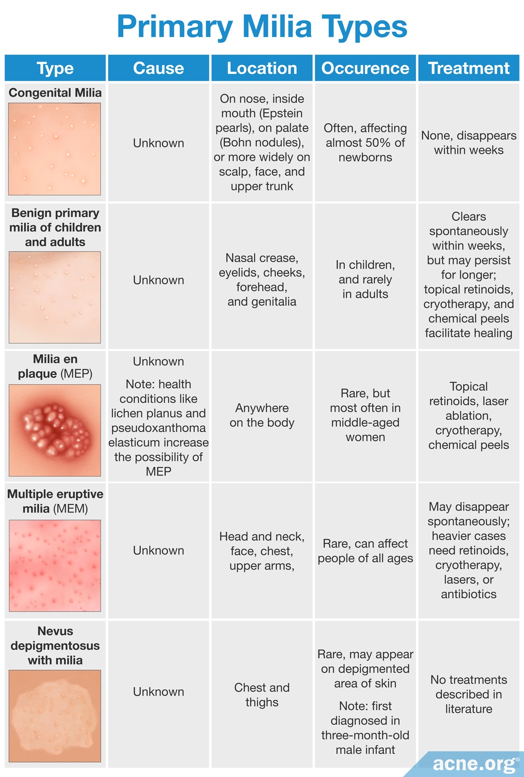 What Are Milia, and Do They Relate to Acne? - Acne.org