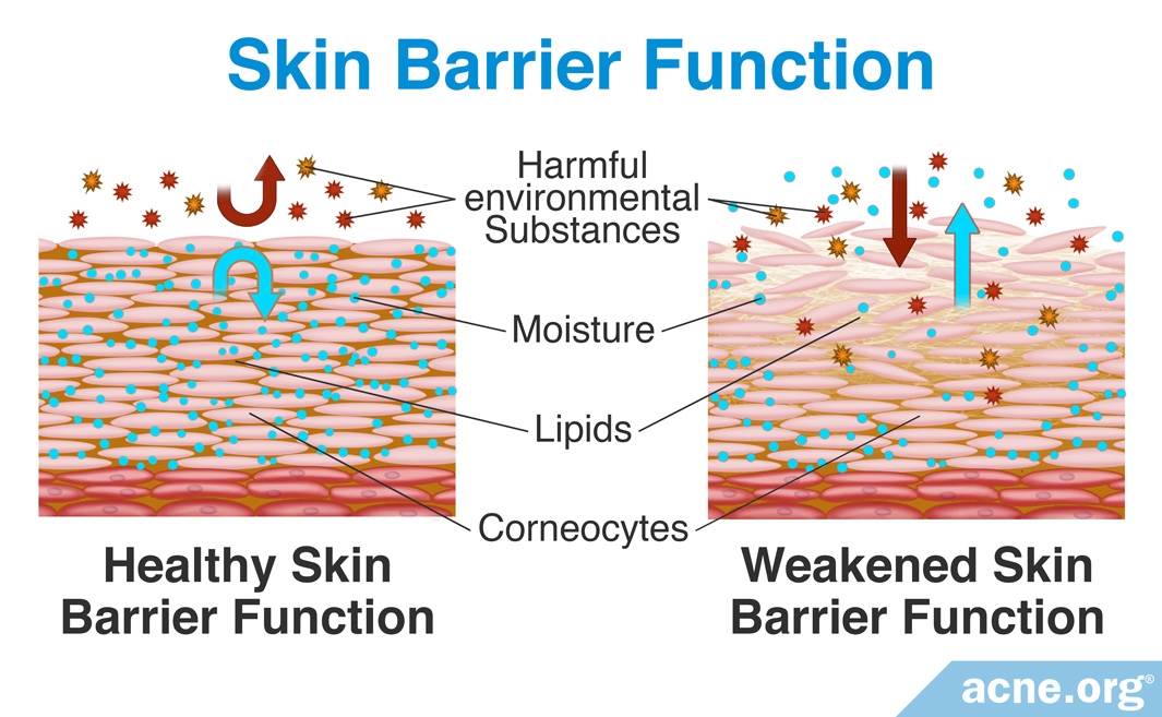 What Is Mineral Oil, and Is It Safe to Use on Acne-prone Skin? - Acne.org