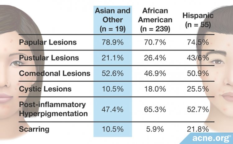 Types of Acne by Ethnicity