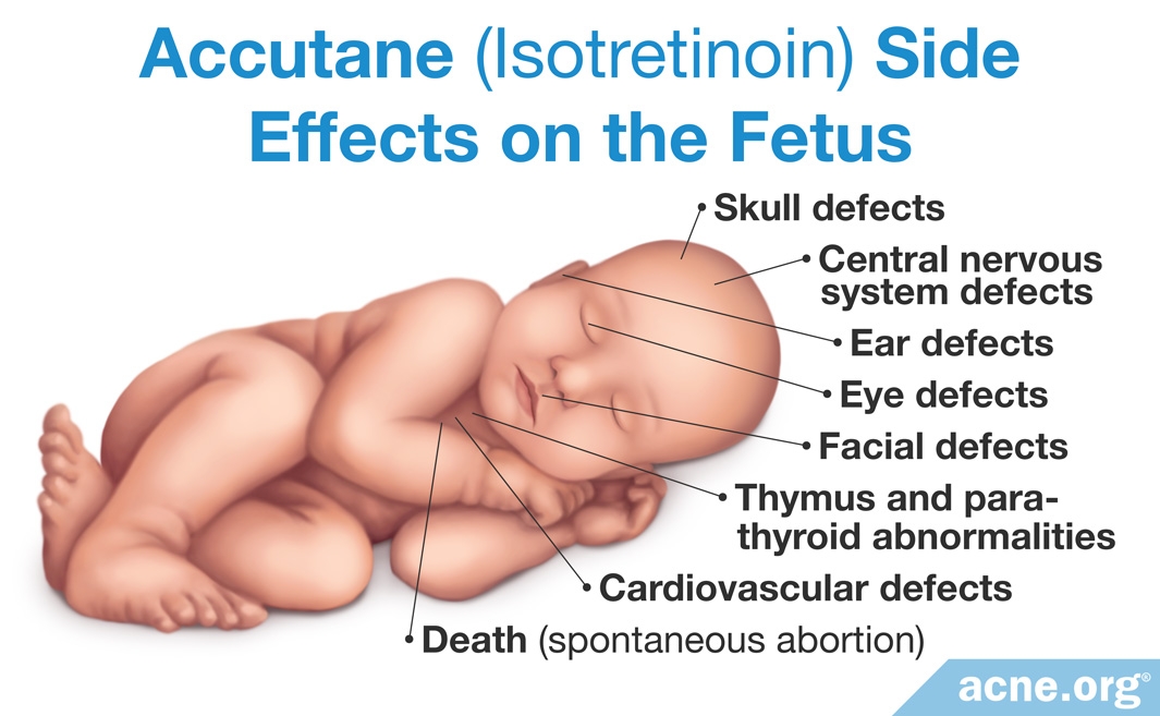 Baby die what from syndrome accutane children