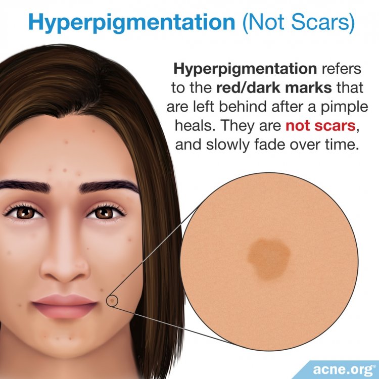 Hyperpigmentation