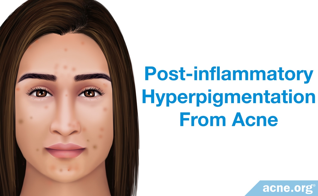 Post-inflammatory Hyperpigmentation from Acne