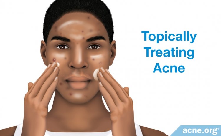 Topically Treating Acne