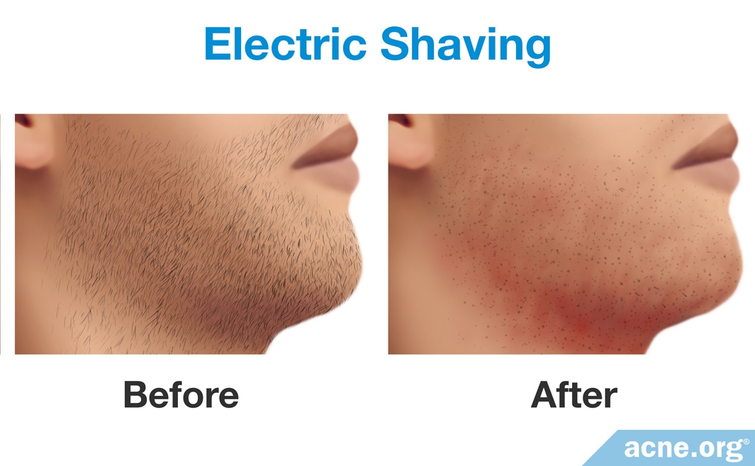 Is Shaving Good or Bad for Acne?