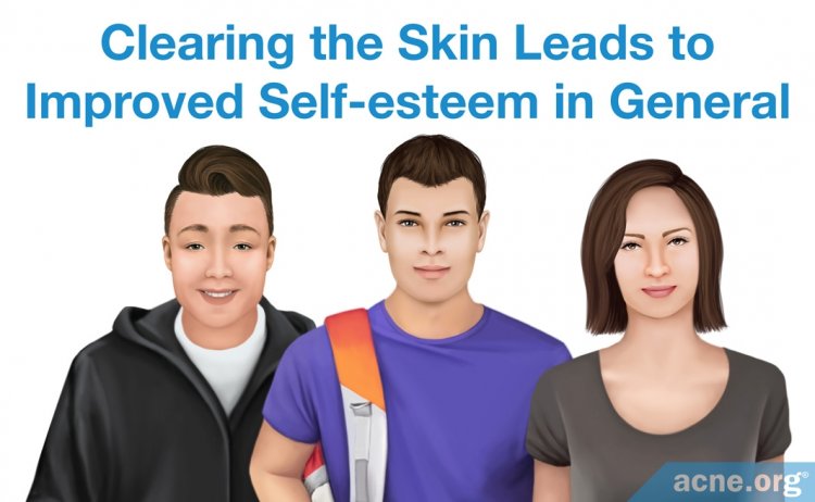 Clearing the Skin Leads to Improved Self-esteem in General