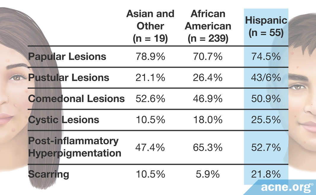 Types of Acne by Ethnicity