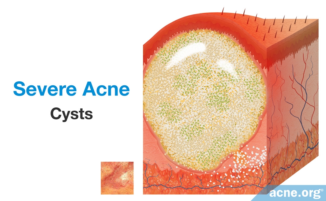 What Is Acne? - Acne.org