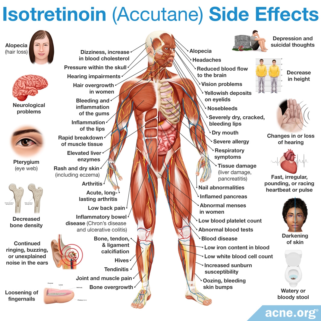 Accutane side effect back pain