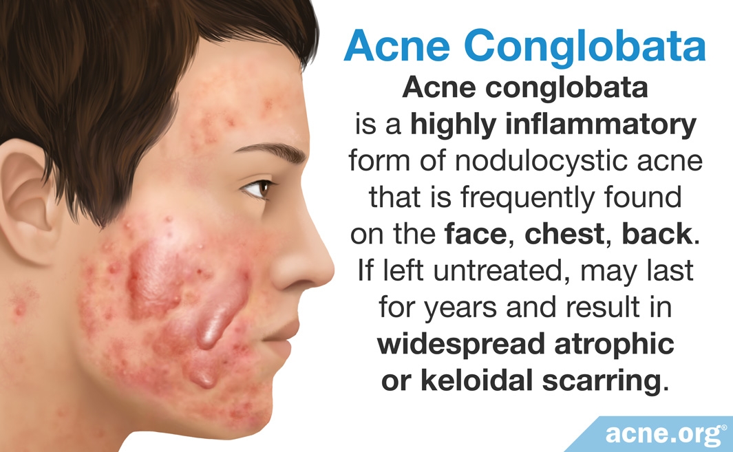 what-is-cystic-acne-acne