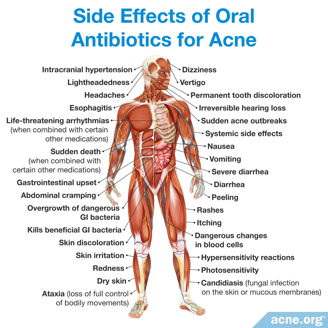 Side Effects of Oral Antibiotics for Acne