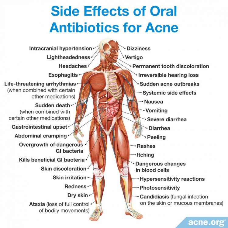 Side Effects of Oral Antibiotics for Acne