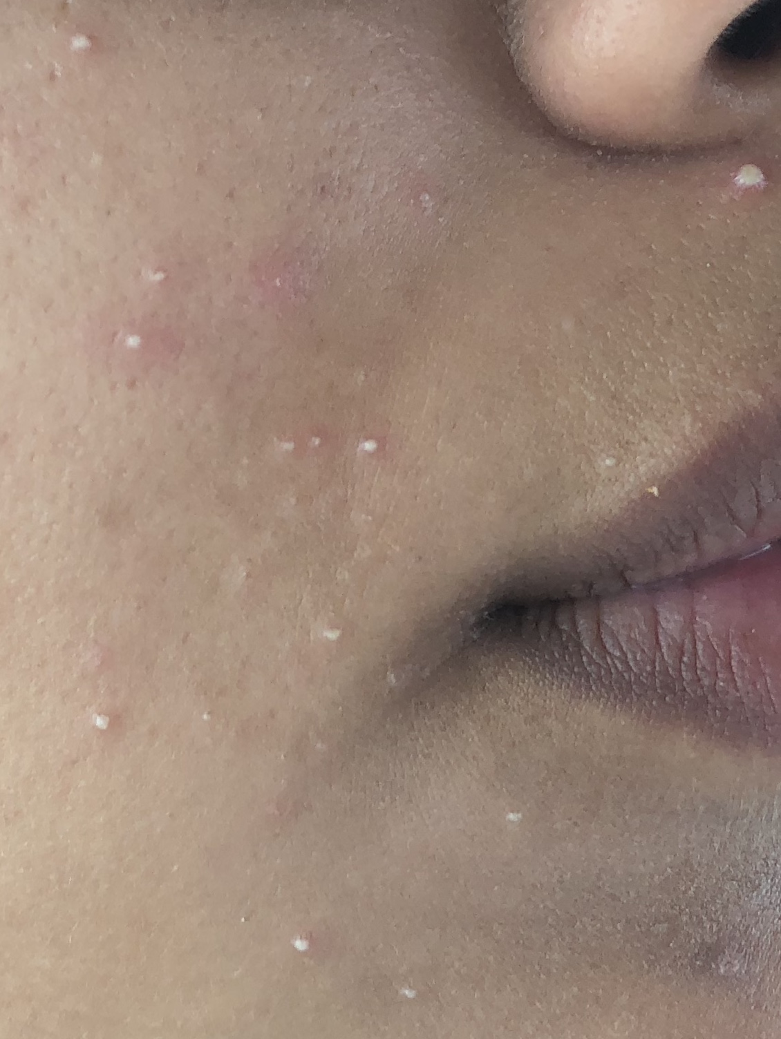 white bumps on cheeks