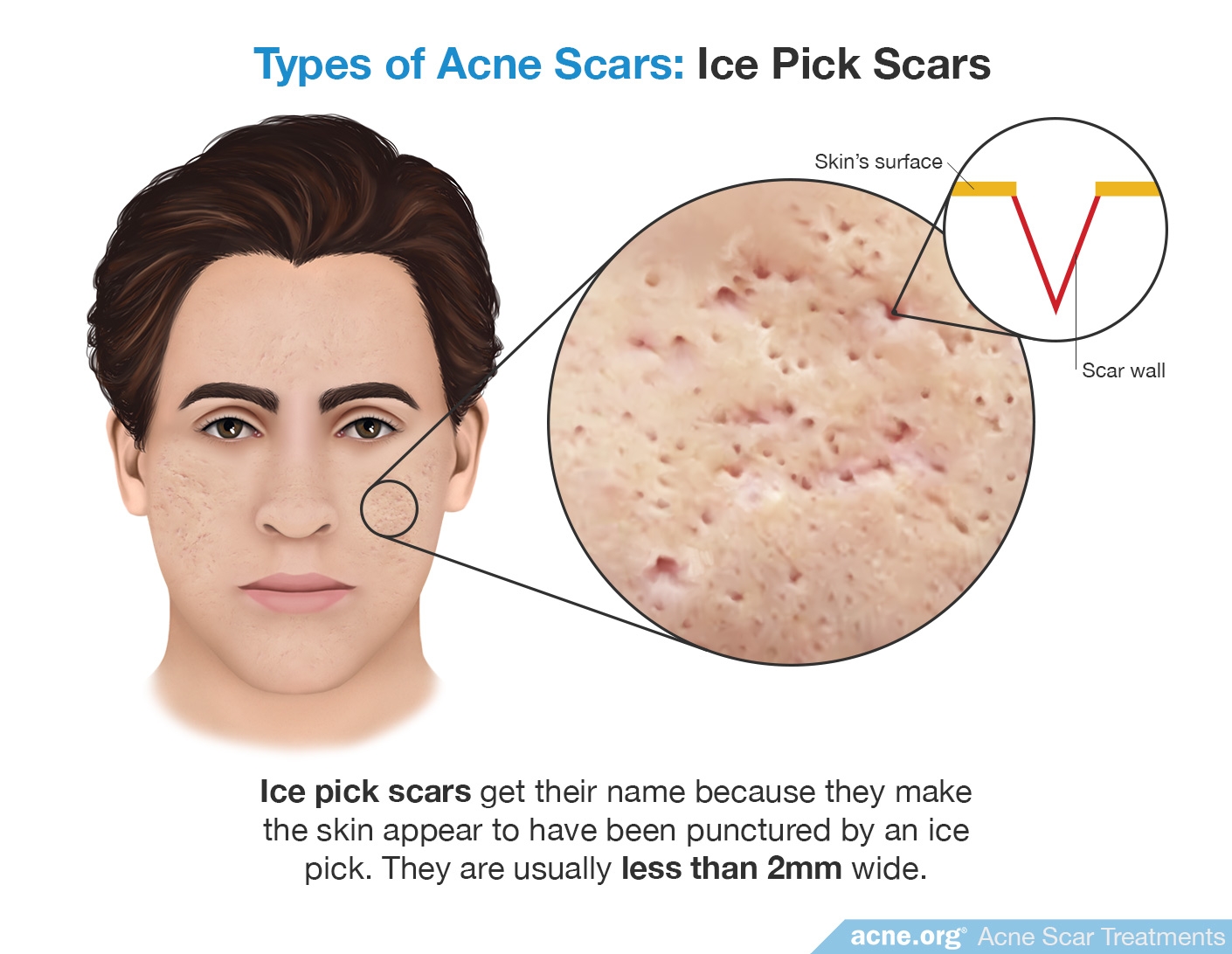 Ice Pick Scars