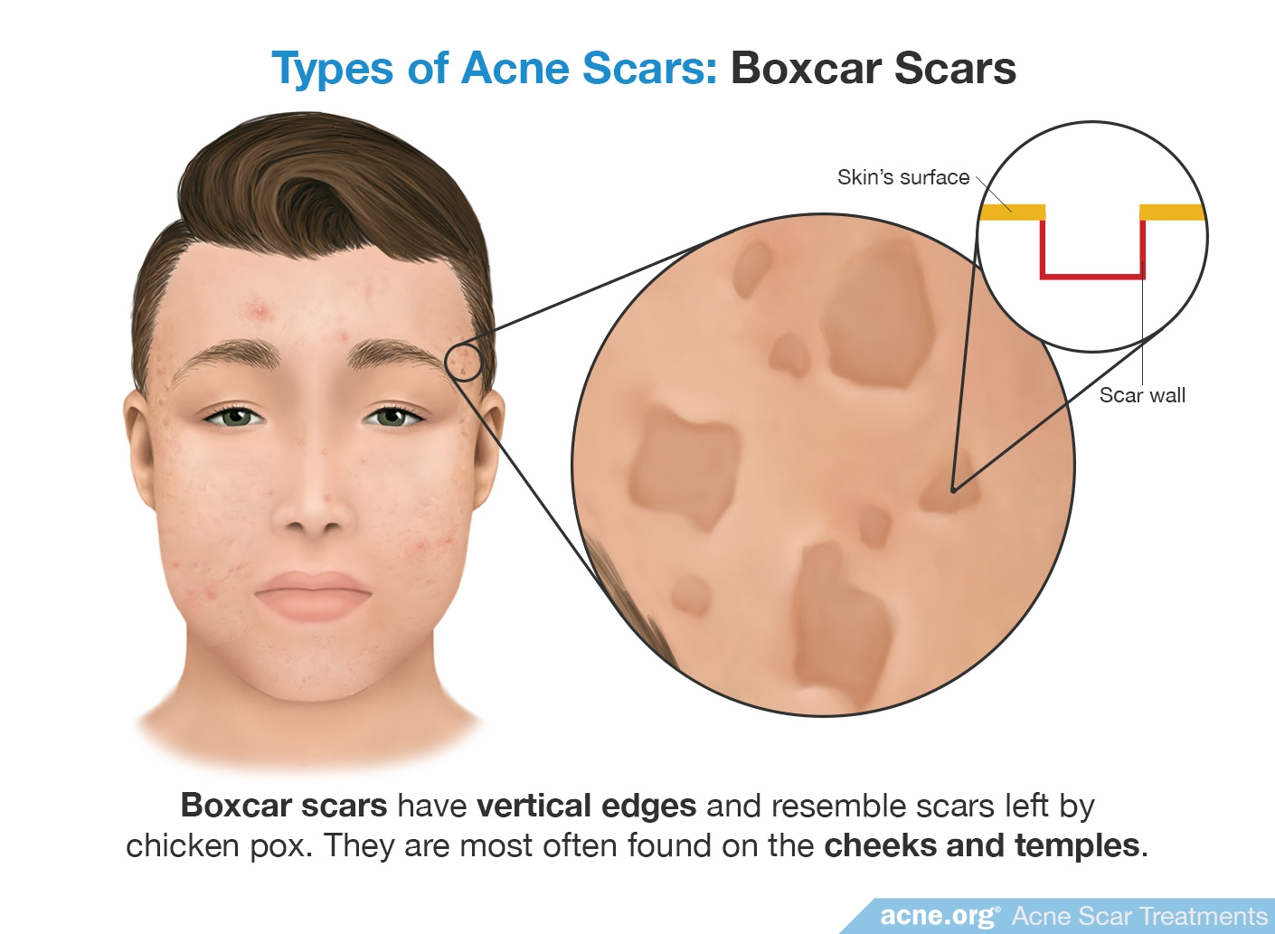 Boxcar Scars