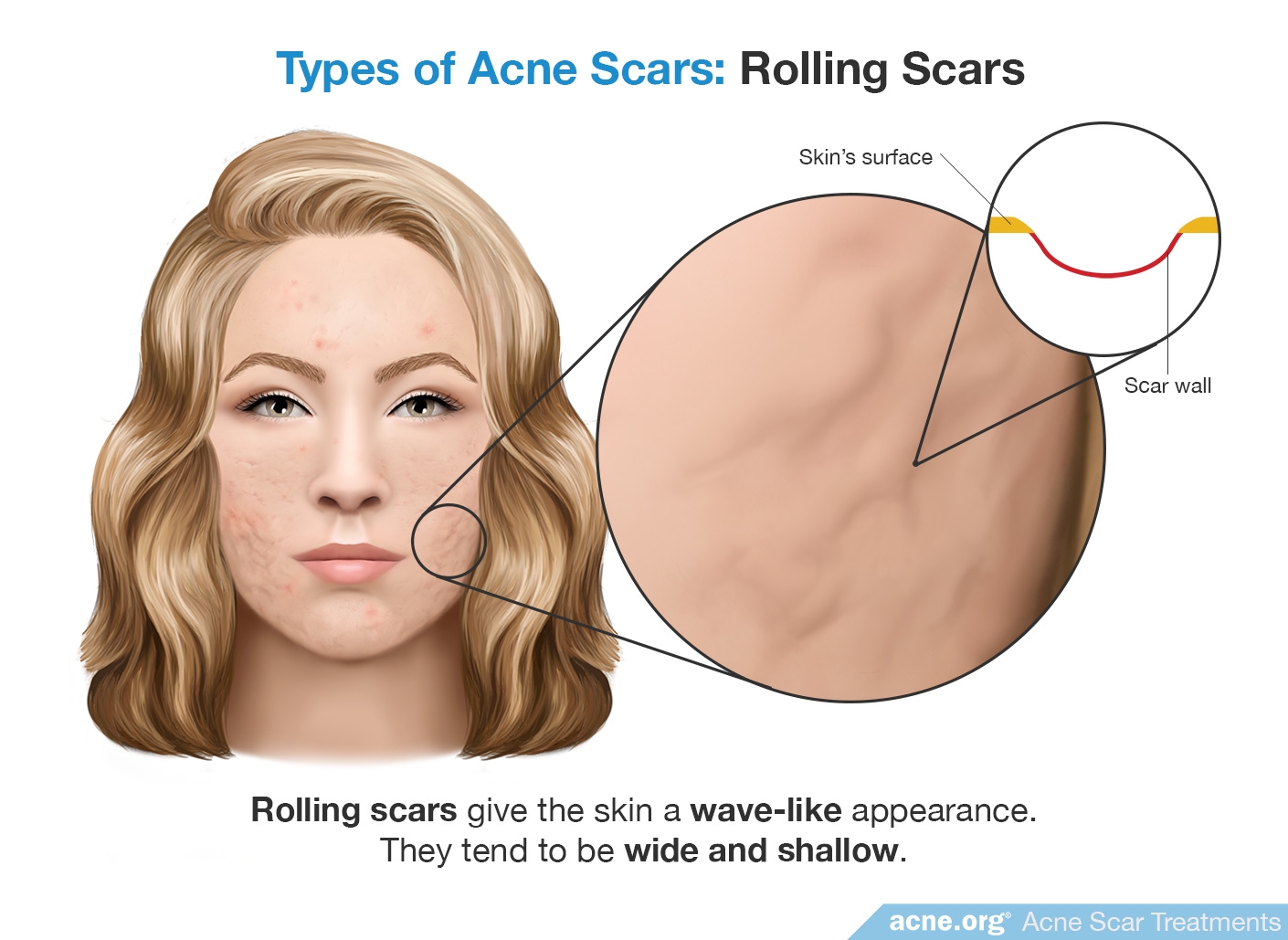 Rolling Scars