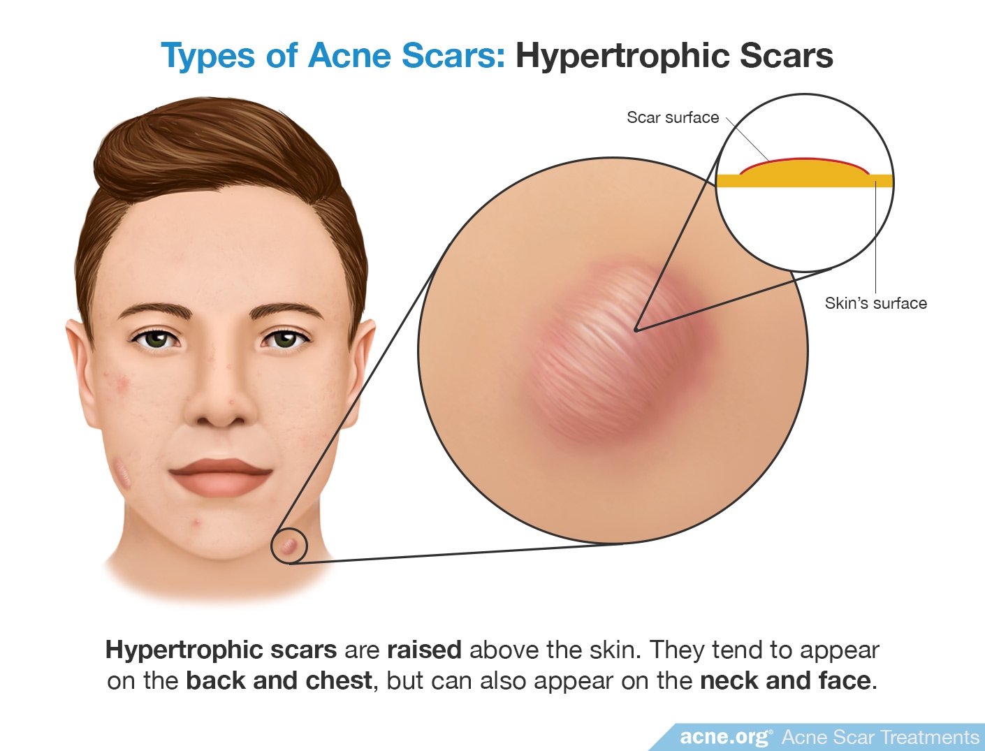 Hypertrophic Scars