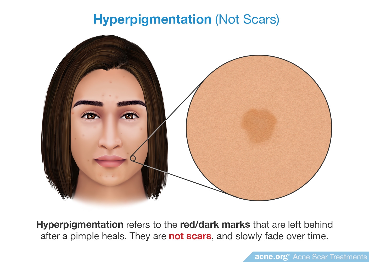 Hyperpigmentation