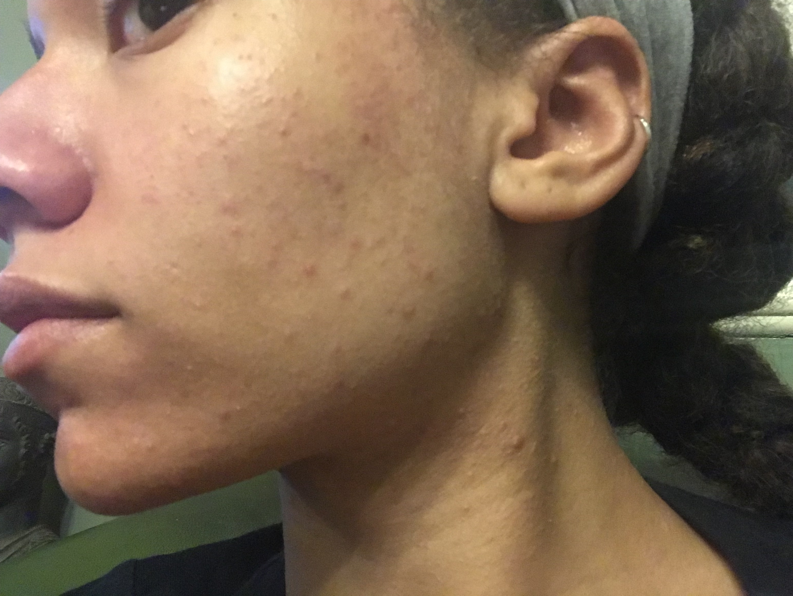 Small Bumps All Over Face Help General Acne Discussion