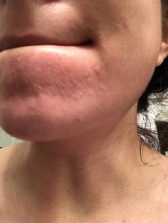 Small flesh colored bumps on chin occasionally cheeks General