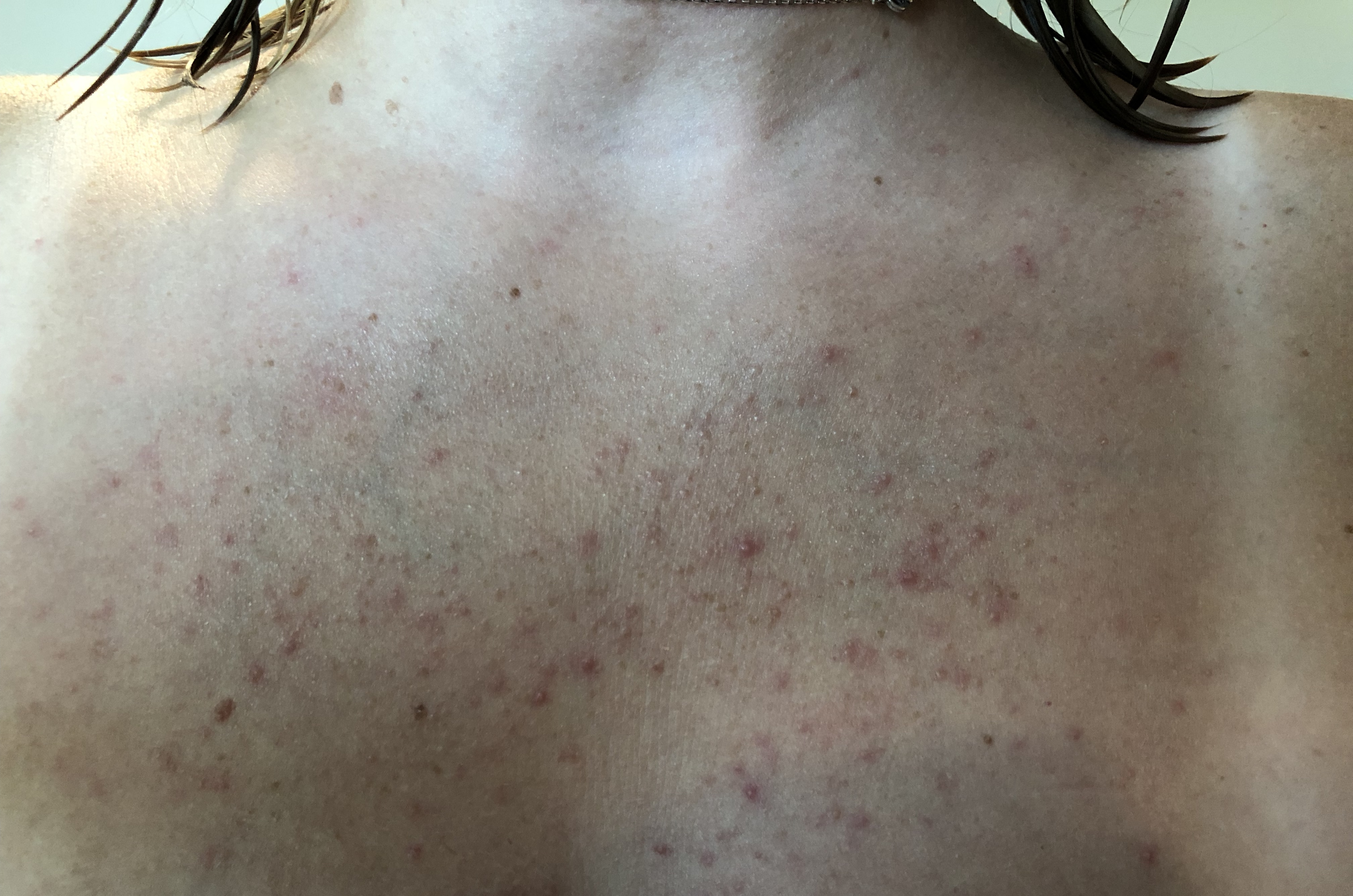 Small Bumps On Chest