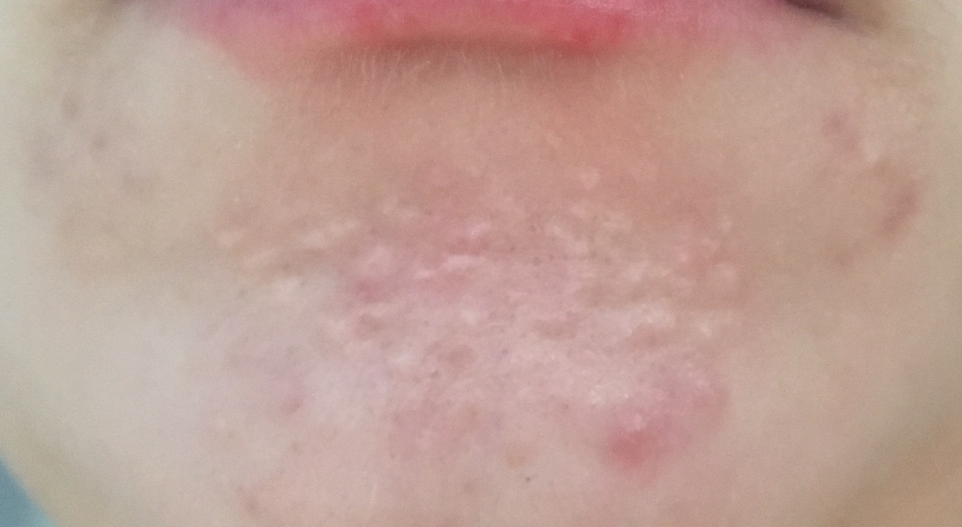 Any Help Identifying What These Bumps Plaguing My Chin Are General