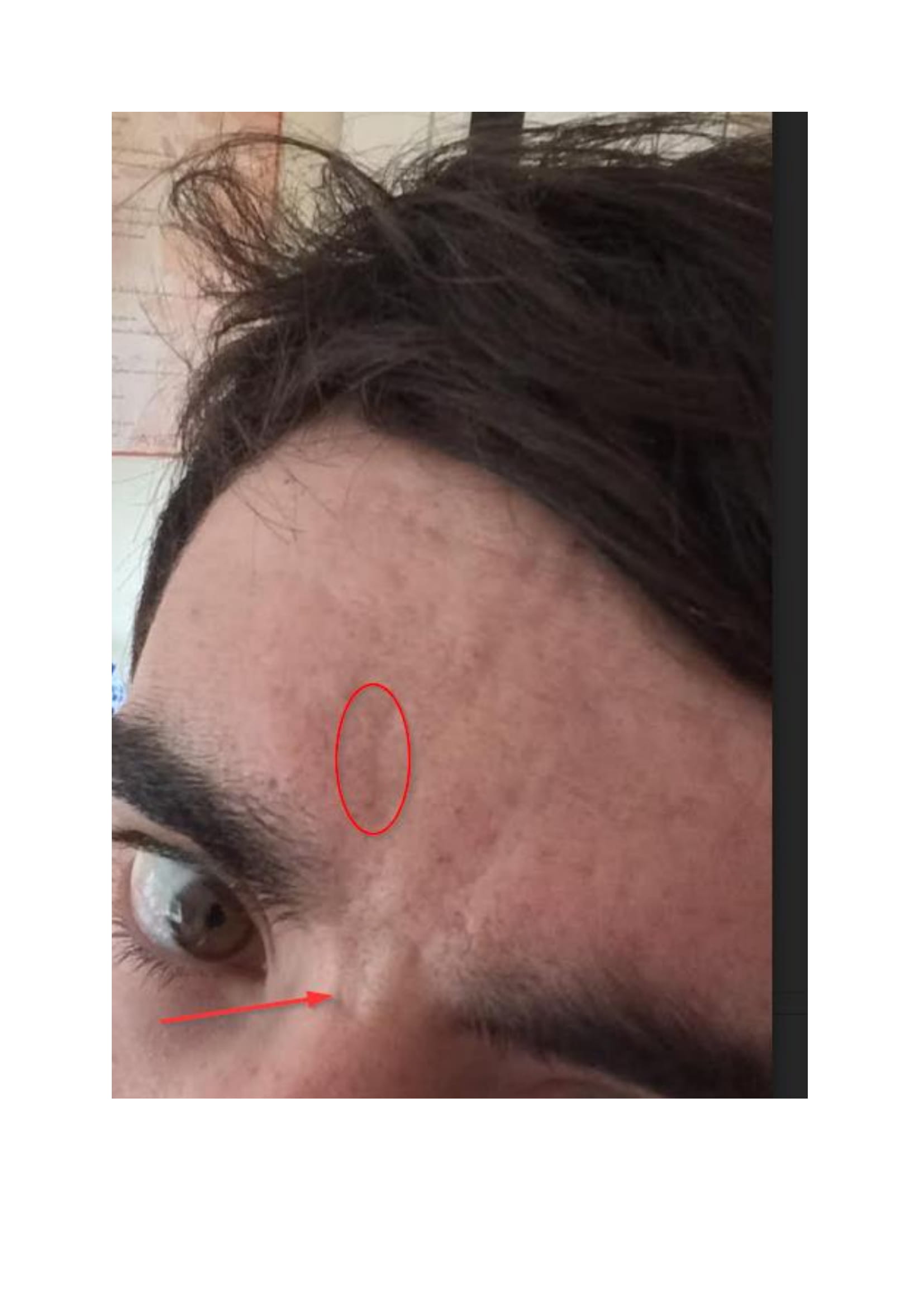 Severe Forehead Scarring Textural Damage How Best To Proceed Scar