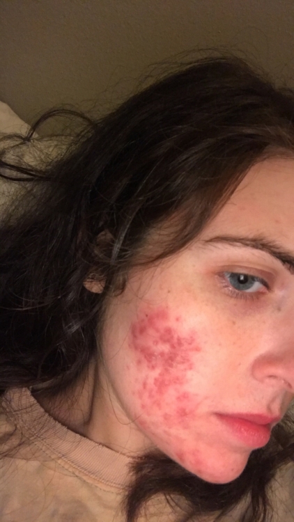 skinupdate2.jpeg