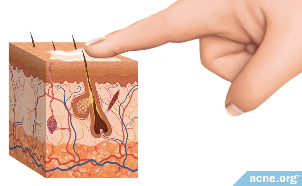 How Acne Treatments Absorb Into the Skin
