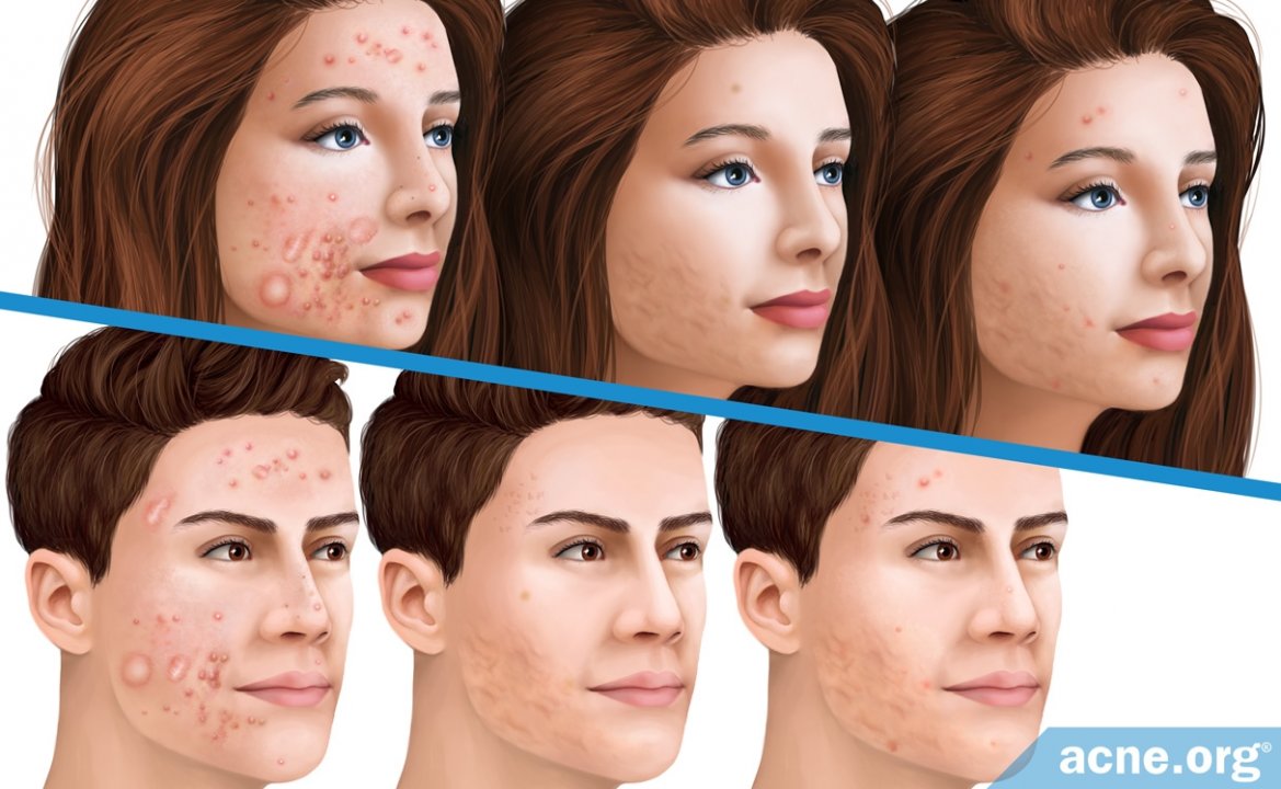 What Is the Actual Relapse Rate of Accutane (Isotretinoin)?