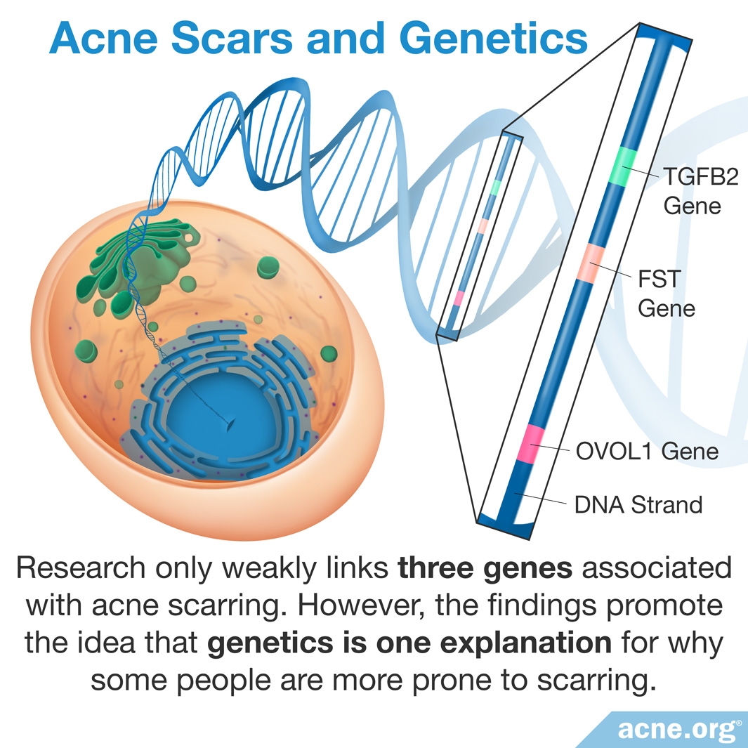 What Causes a Pimple to Scar? - Acne.org