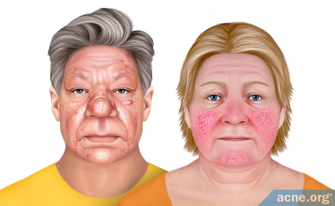 Rosacea
