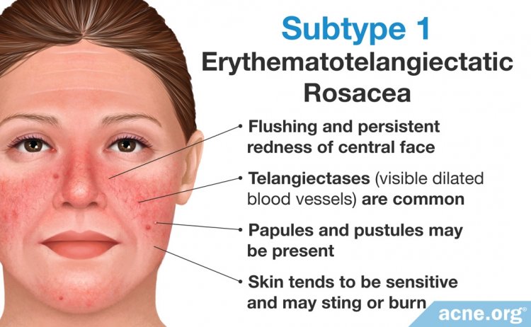 Subtype 1: Erythematotelangiectatic Rosacea