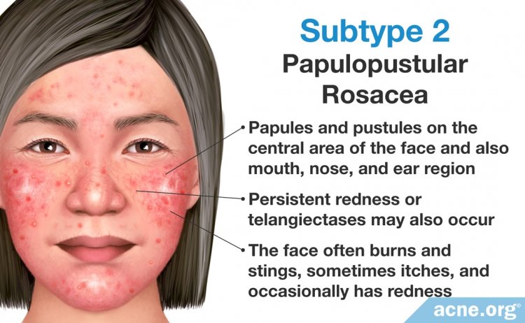 Subtype 2: Papulopustular Rosacea