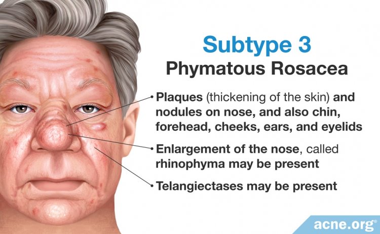 Subtype 3: Phymatous Rosacea