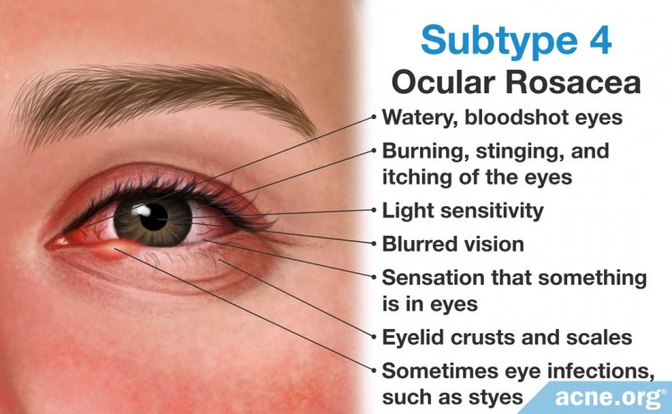 Subtype 4: Ocular Rosacea