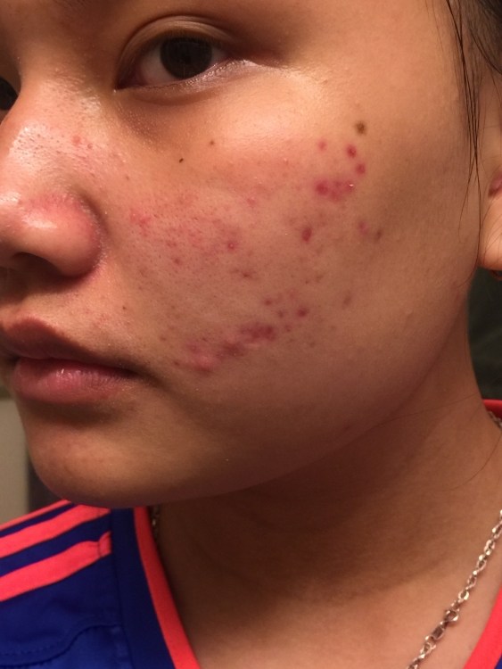 ROUTINE HELP FOR RED ACNE MARKS Hyperpigmentation Red dark Marks 