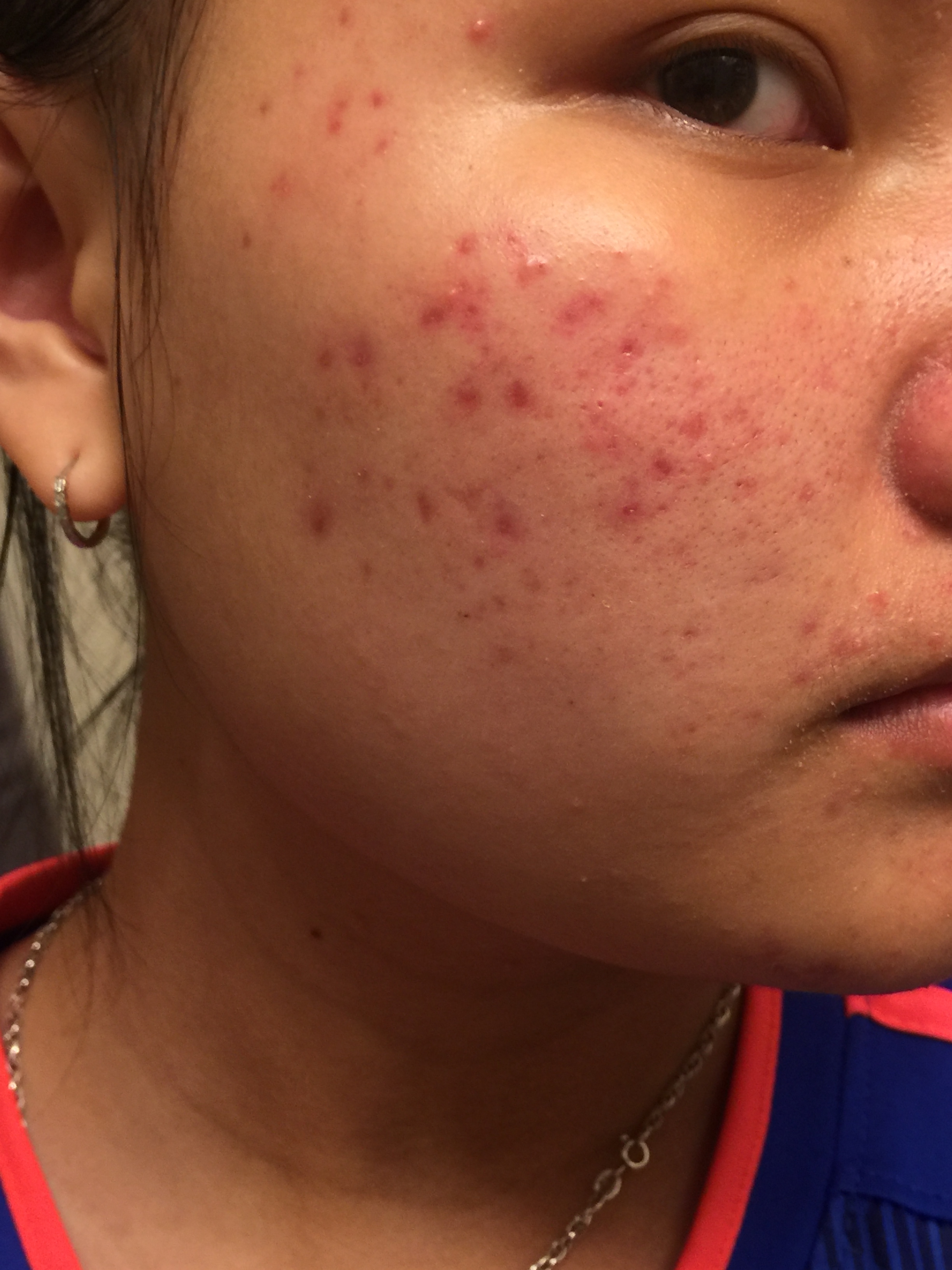 ROUTINE HELP FOR RED ACNE MARKS Hyperpigmentation Red dark Marks 