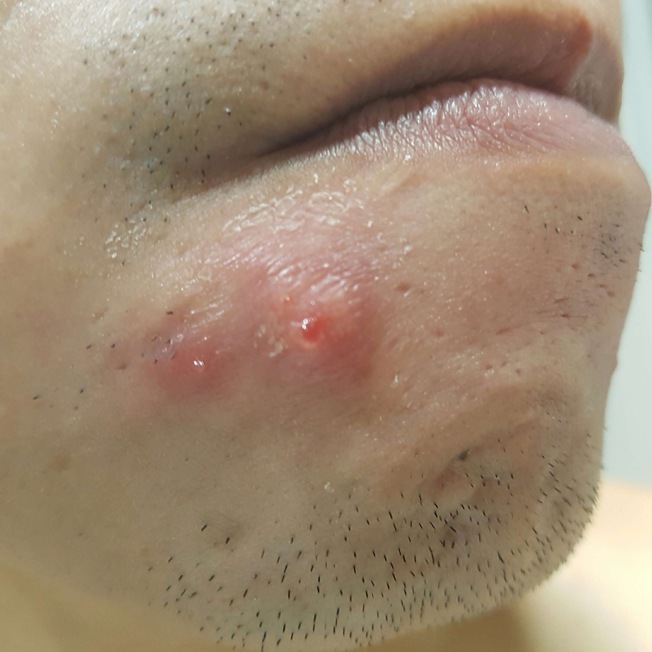 does-anyone-know-what-this-is-red-lump-general-acne-discussion