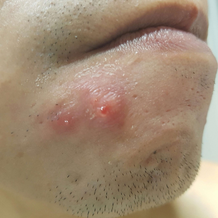 Does anyone know what this is? Red lump - General acne discussion