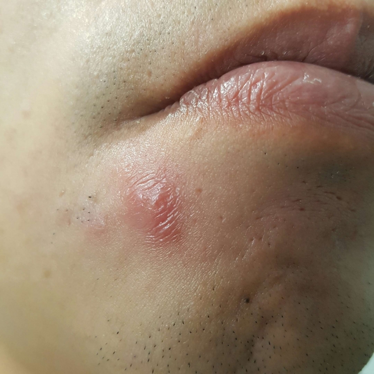 Does anyone know what this is? Red lump - General acne discussion