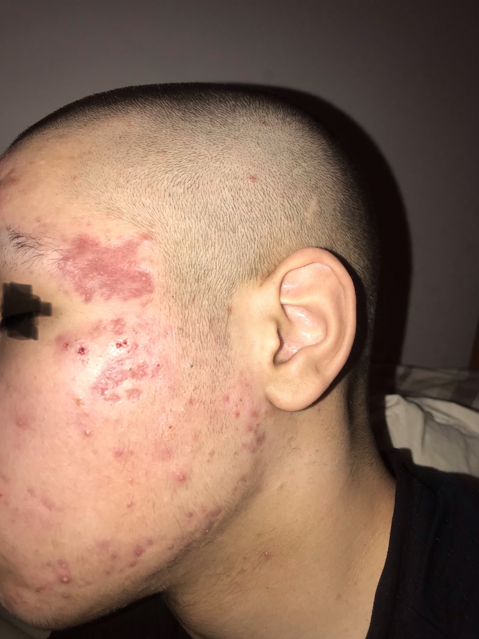 What acne scars are these and what treatments are best for my scars