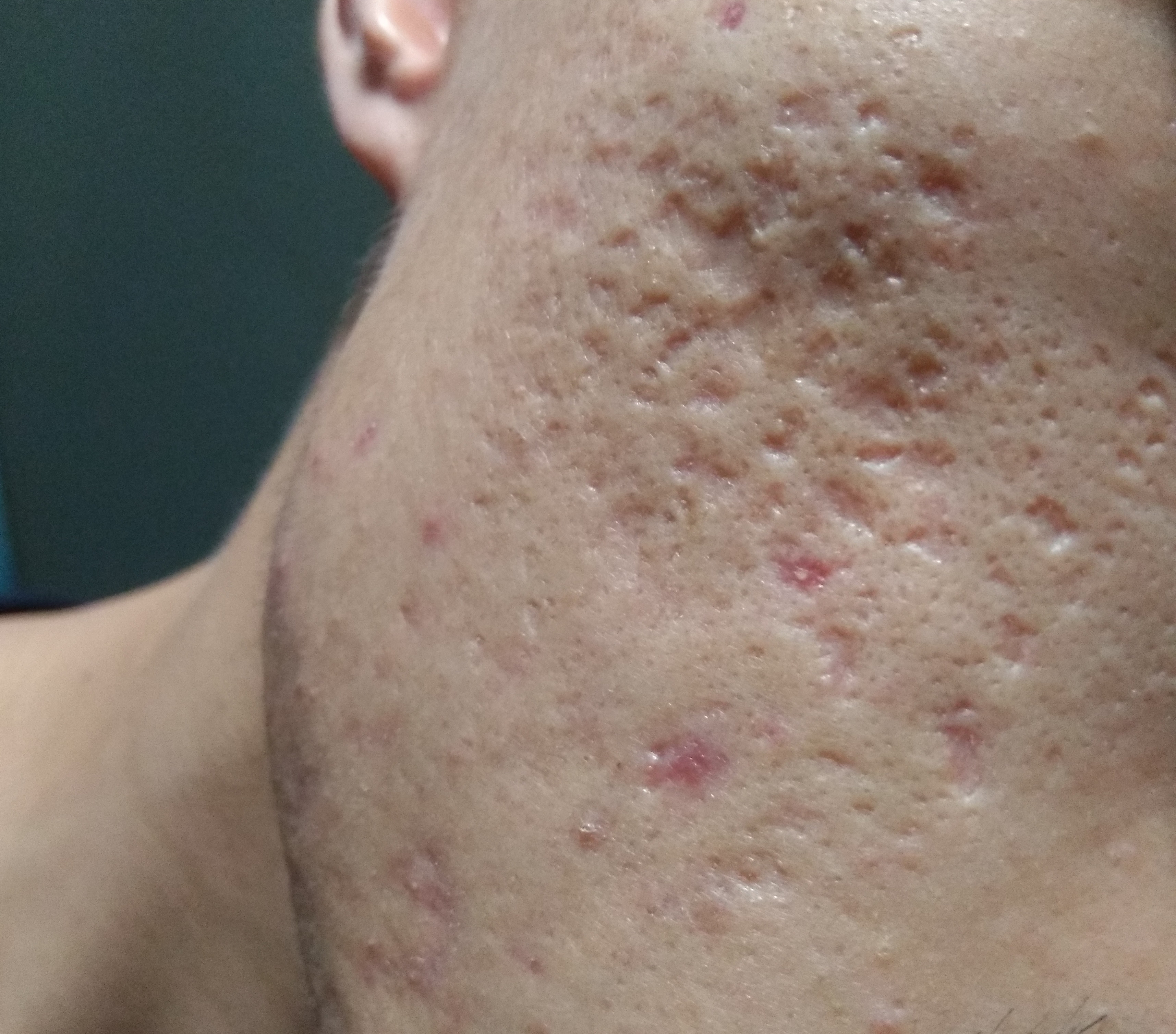 Need help for my acne scar!!! - Scar treatments - Acne.org