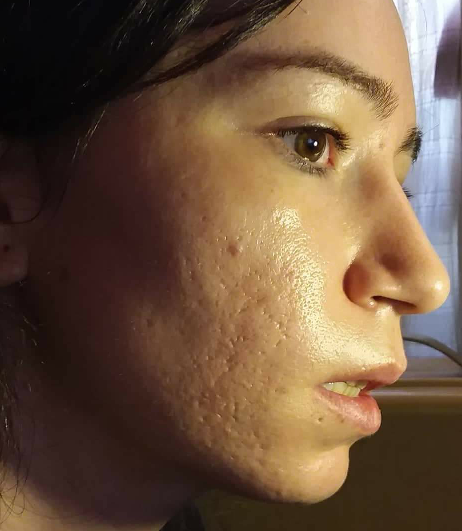 Please help my acne scars – Scar treatments – Acne.org Forum