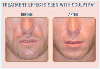 sculptra2download.jpg