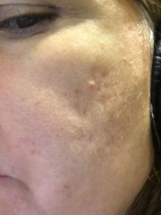acne 1.jpg