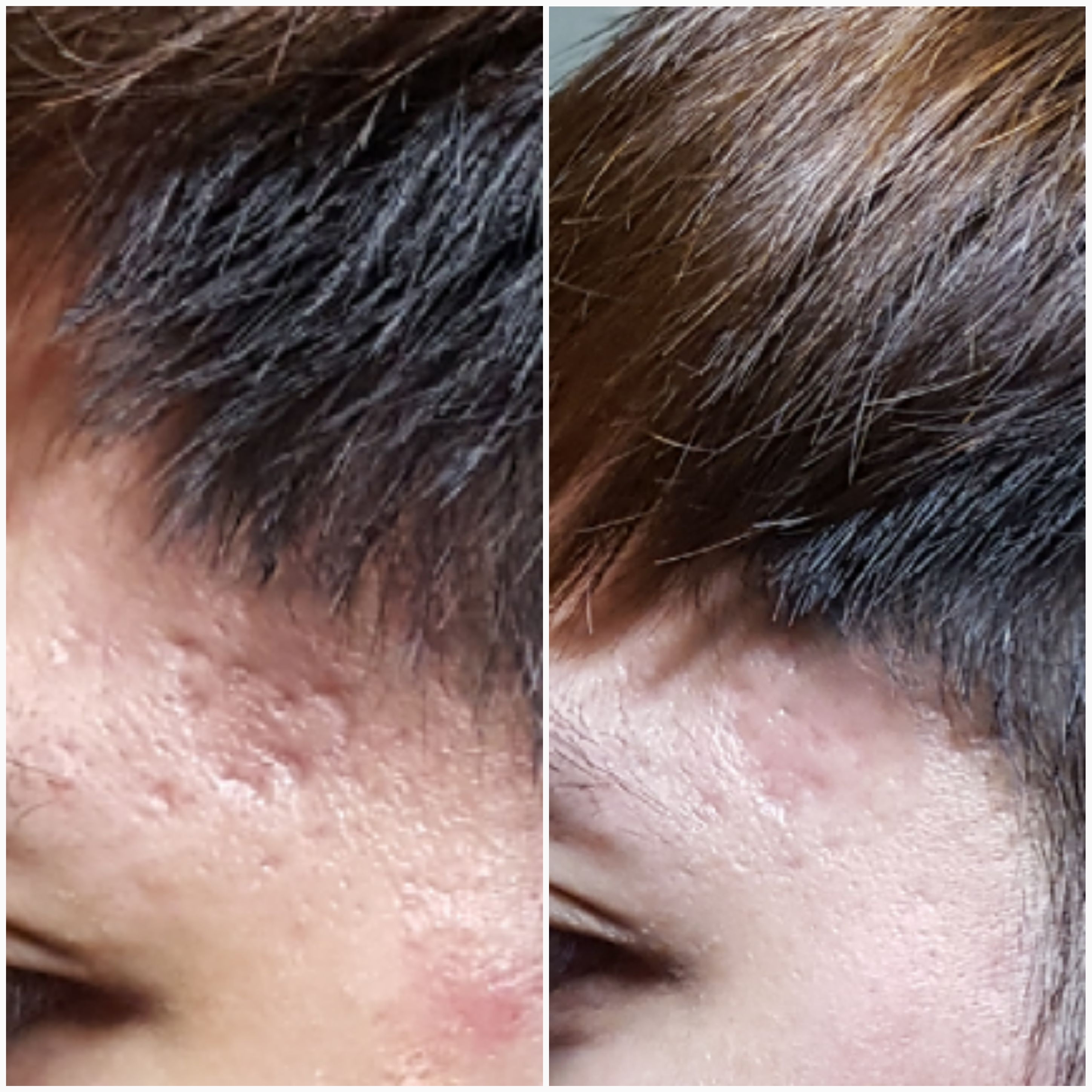 Microneedling For Acne Scars Before And After Before And After