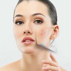 Natural Remedies for Acne