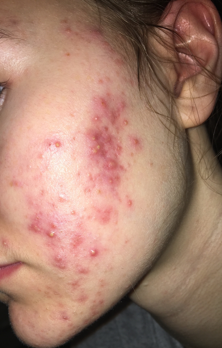 what type of acne is this and how do i treat it?