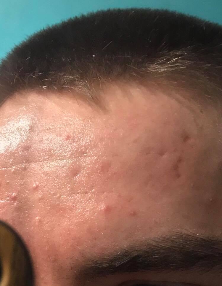 Deep Indentation In The Middle Of My Forehead Scar Treatments