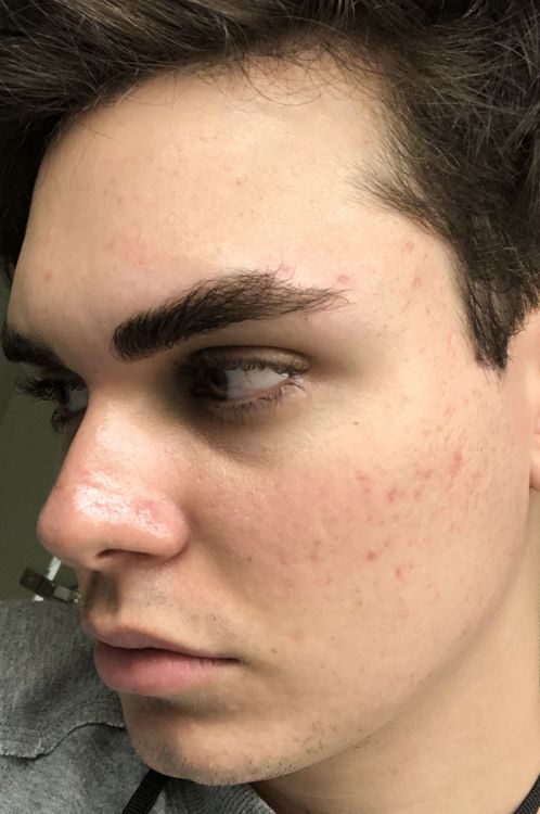 Acne After.jpg
